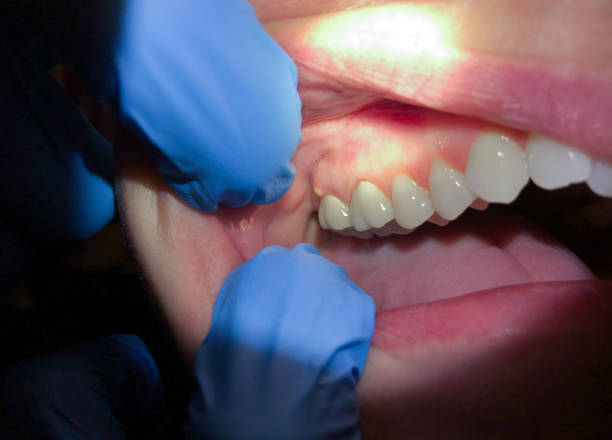 Best Knocked-Out Tooth Emergency  in Mills, WY